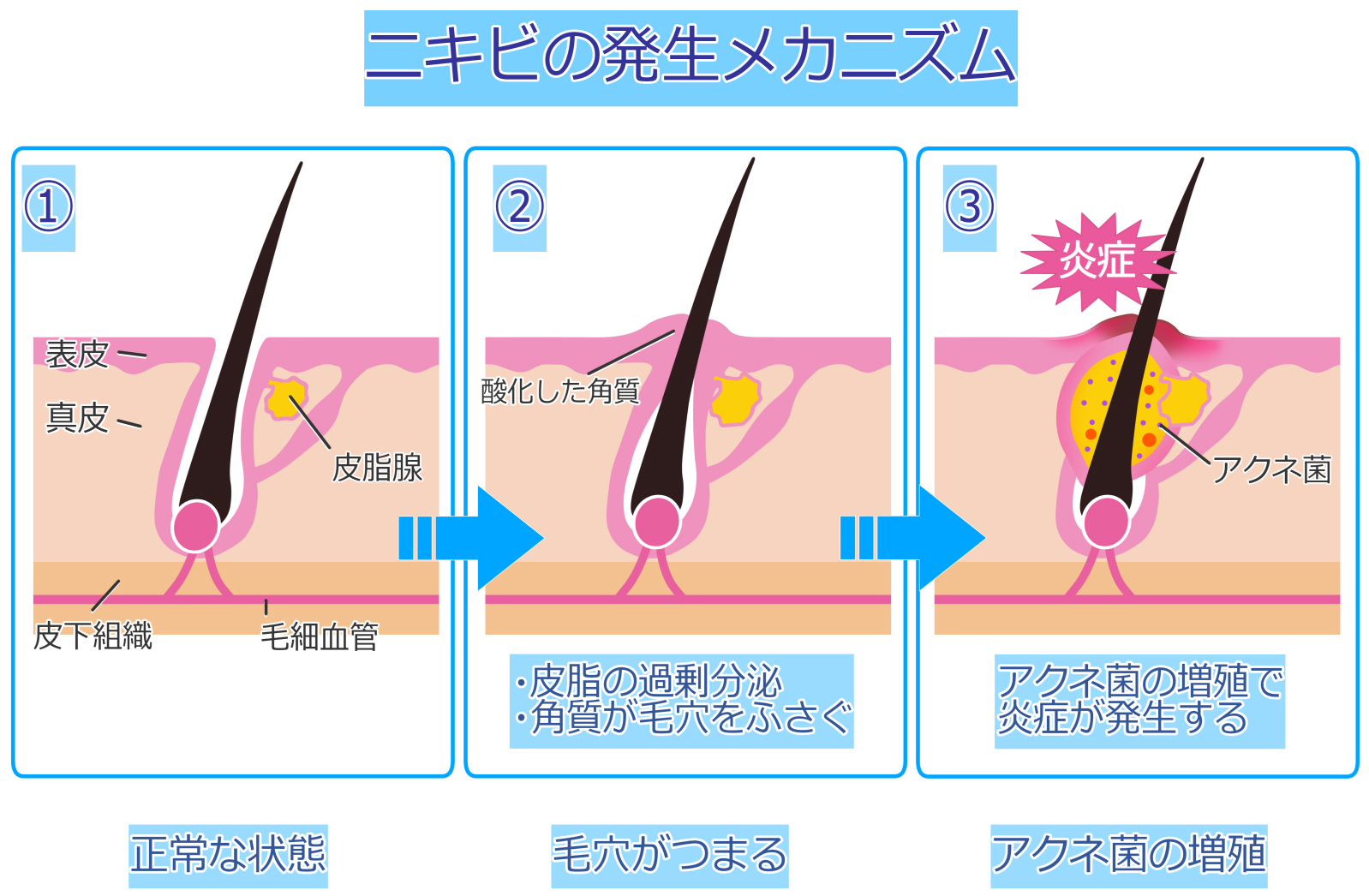 ニキビが発生するメカニズム