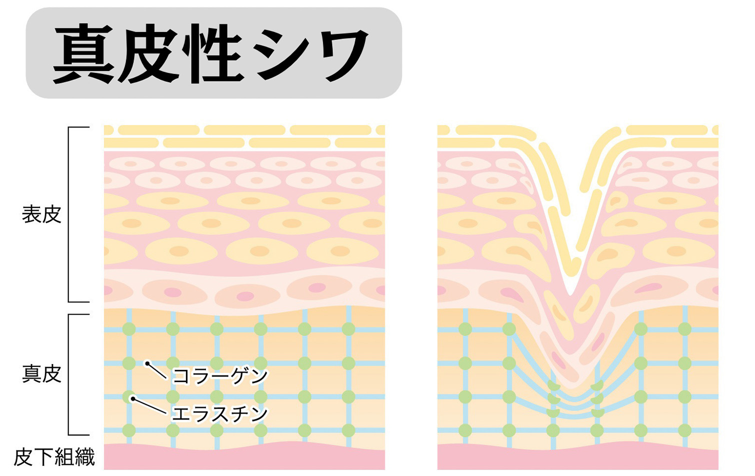 真皮性シワのイメージ