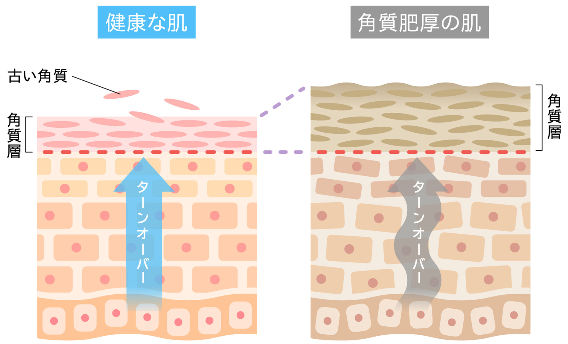 角質肥厚のイメージ