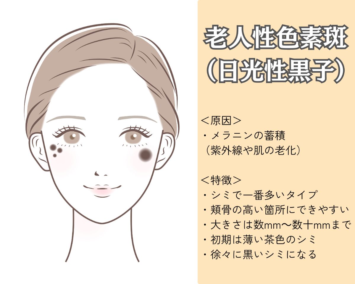 老人性色素斑（日光性黒子）とは