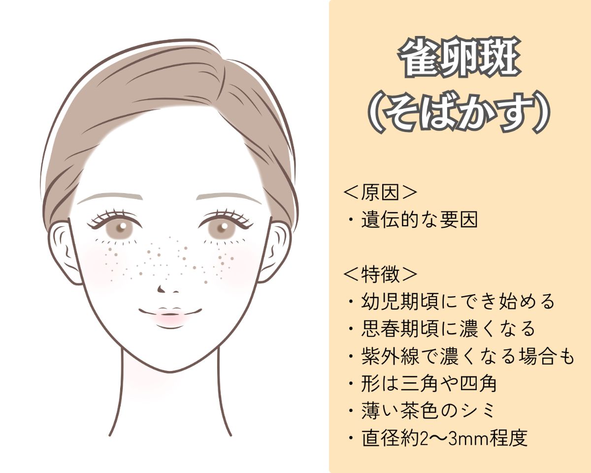 雀卵斑（そばかす）とは