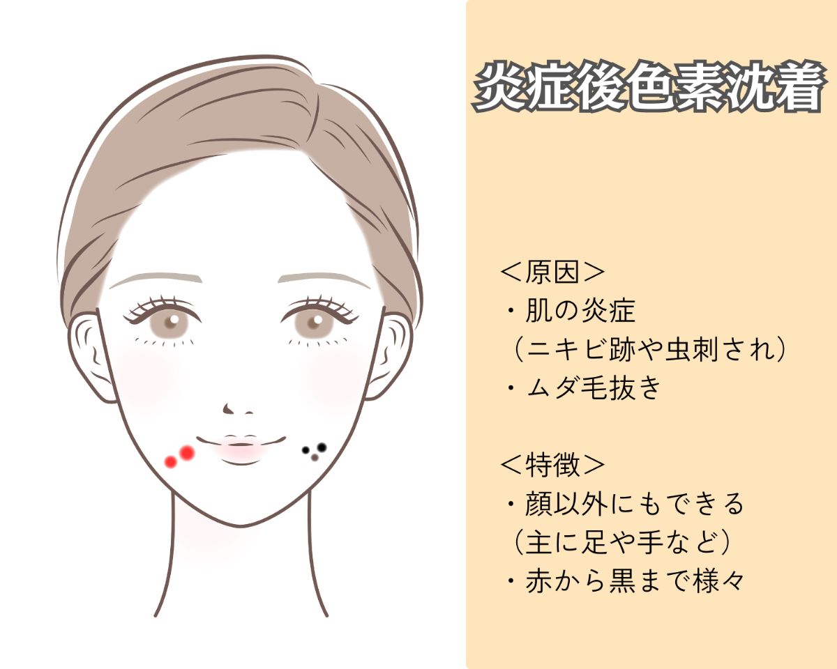 炎症後色素沈着とは