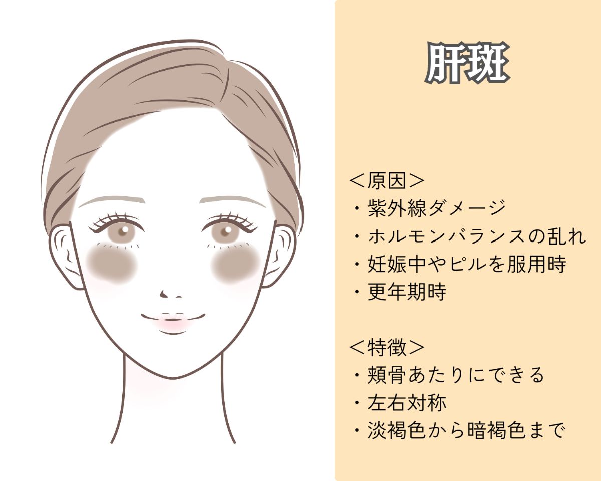 肝斑とは
