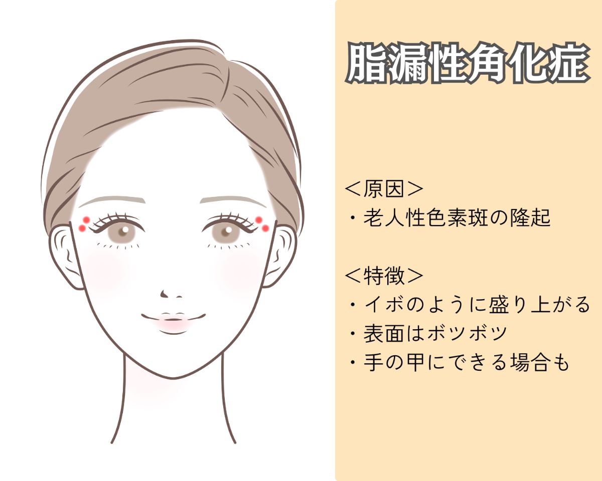 脂漏性角化症とは